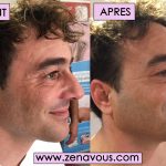 AVANT APRES FRED